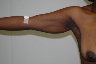 Arm Lift (brachioplasty) 333738