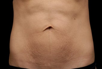 Body contouring after 380982