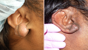 Earlobe Repair before 293449