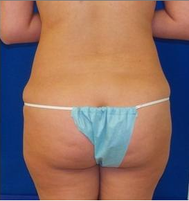Laser Liposuction 220308