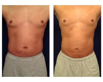 Liposuction before 286847
