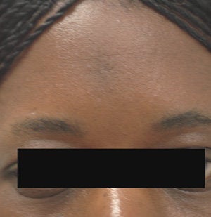 Scar Removal for Black Skin after 179173