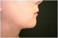 Chin Implant after 302192
