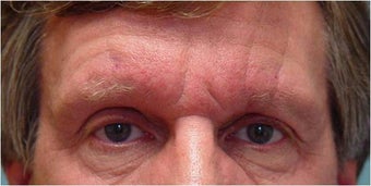 Botox frown lines before 251660