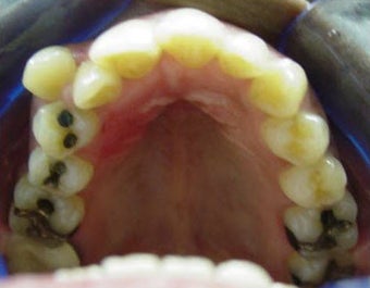 Invisalign 437118