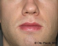 Lip Reduction after 565920