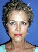 Liposuction after 602753