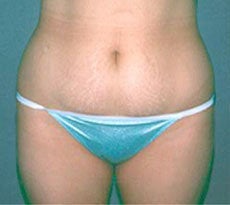 Smartlipo before 401651