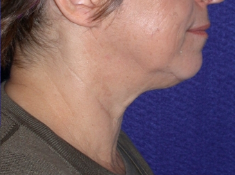 Necklift 208443