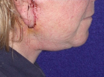 Necklift 208458