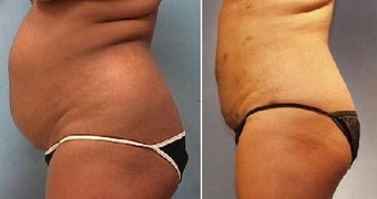 Smartlipo Abdomen before 212251