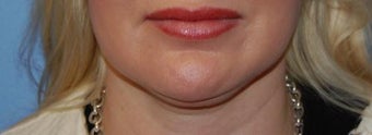 Lip Augmentation before 399262