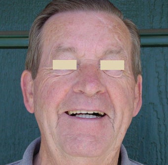 Dentures before 109193