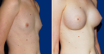 Breast Implants after 494493