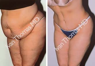 Tummy Tuck before 242519