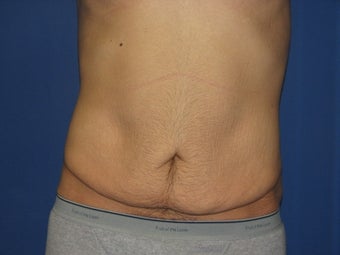 Male Tummy Tuck before 576569