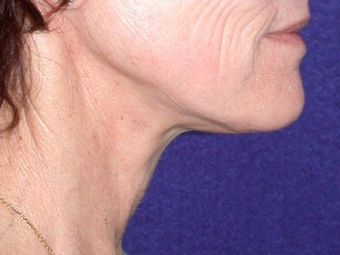 Necklift 208444