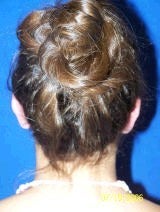 Ear Surgery (Otoplasty) after 357654