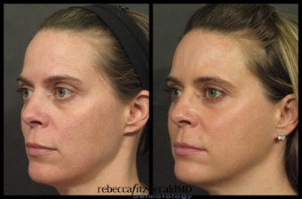 Sculptra after 316994