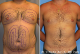 Male Breast Reduction before 217797