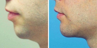 Chin Implant before 642998
