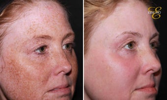 Laser Resurfacing before 342194