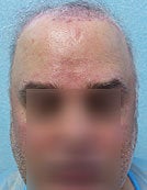 FUE – BHT Using Beard and Body Hair Only 2,000 graft repair using Stomach, Arm, and Leg donor hair before 196033