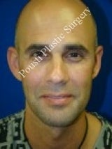 Ear Surgery (Otoplasty) before 579096
