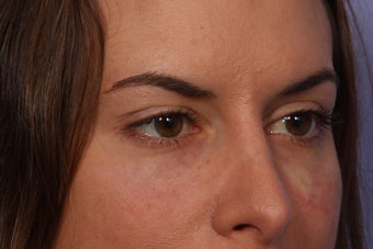 Restylane to Tear Troughs (under eyes) 308348