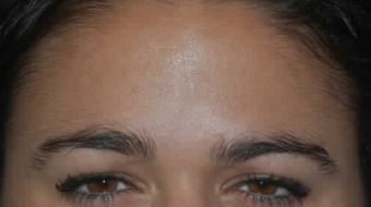 Botox to Treat Frown Lines and Vertical Lines Between Eyebrows after 53758