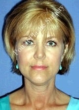 Liposuction before 602753