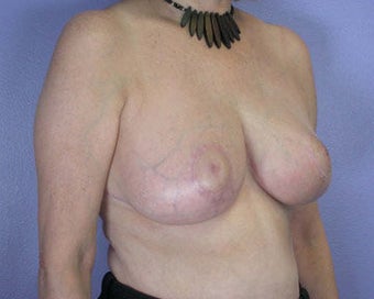 Breast Reduction after 285308