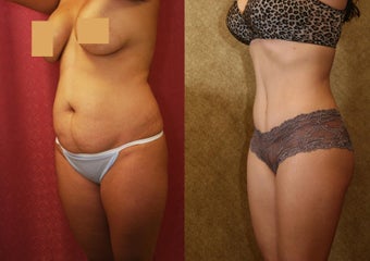 tummy tuck before 637904