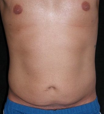 Male tummy Tuck, Flank Liposuction before 578199