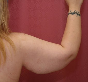 Brachioplasty or arm tuck 583681
