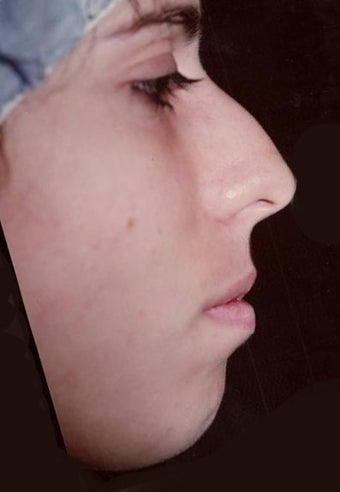 Rhinoplasty before 355872