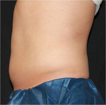 CoolSculpting after 421630