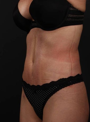 Full tummy tuck revision 356434