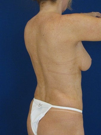 Vaser Hi Def Liposuction of chest, abdomen, back and flanks 422725