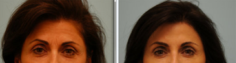 Botox before 362761
