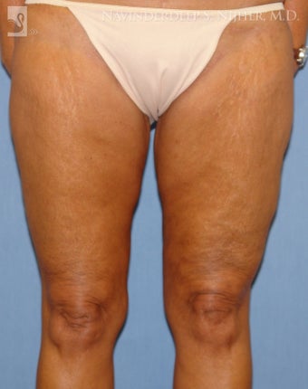 Thigh Lift after 502544