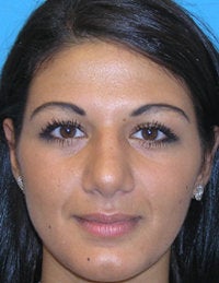 Reduction Rhinoplasty after 52523