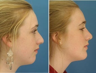 Rhinoplasty with Chin Implant young girl before 6773