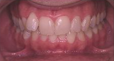 Invisalign before 353426