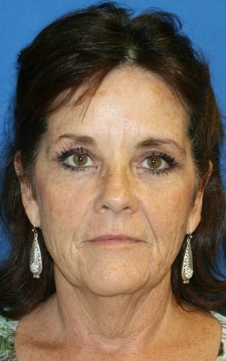 1 month pot-op: Facelift, Necklift, Neck Liposuction, Fat Transfer, and Browlift 424191
