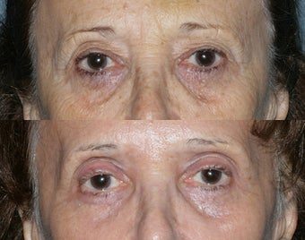Fraxel Repair in Combination with other lasers yields best results before 149674