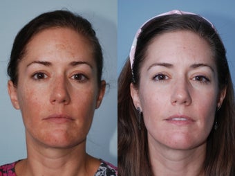 Cosmion Mask and M2 Treatment of Melasma before 353872