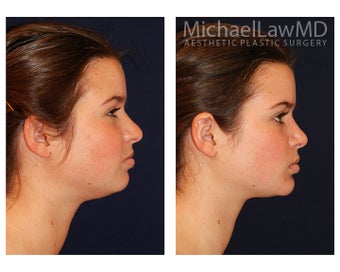 Chin Liposuction 395814