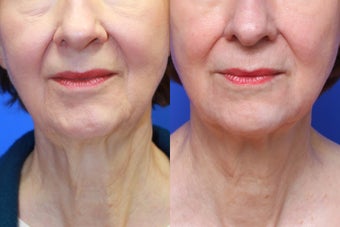 Exilis Skin Tightening before 619571