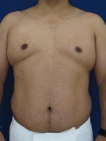 Vaser Hi-Def Liposuction of abdomen, chest, back and flanks before 422693